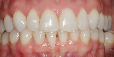 smile-invisalign-after-01