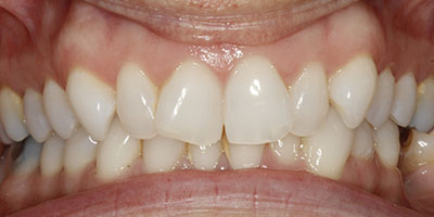 smile-invisalign-before-01