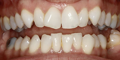 smile-invisalign-before-02